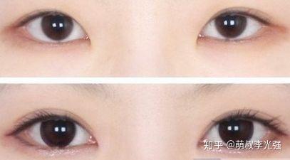 最新双眼皮手术观点阐述与介绍