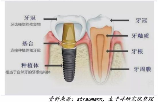 种植牙集采最新动态，温馨日常故事揭示行业变化